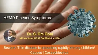 Hand Foot and Mouth Disease ! Beware! This disease is spreading rapidly&nbsp;among&nbsp;children! Dr.Goel, MD