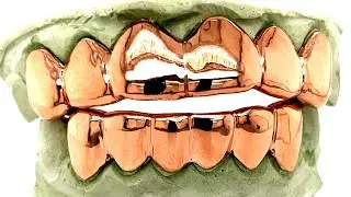 6 Top 6 Bottom 10k Rose Gold Grillz with High Polish by @SeattleGoldGrills