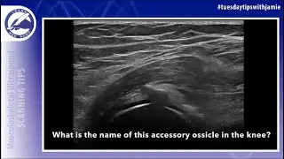 Do you know the name of this accessory ossicle in the posterolateral knee?