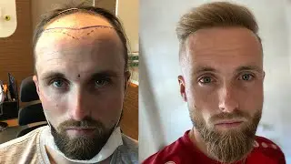 Trapianto di capelli prima e dopo in avanzamento rapido