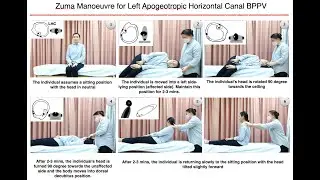 Zuma Manoeuvre for Left Apogeotropic Horizontal Canal BPPV