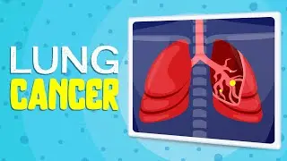 How to detect Lung cancer early? Lung cancer screening & prevention