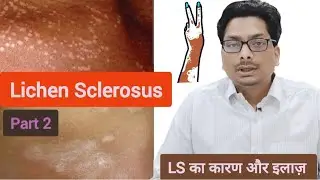 Lichen Sclerosus - Part 2 | Cause & Treatment | LS का कारण और इलाज़ #lichensclerosus #lichenplanus