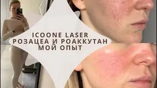 Icoone Laser)мой опыт)Системные ретиноиды при розацеа (роаккутан)