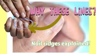 Fingernail Ridges: What Causes Them? #fingernailridges #wellness #nailcare