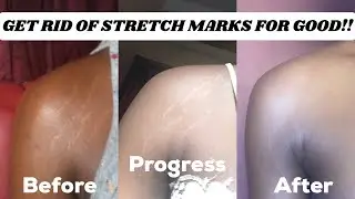 Best effective oils for stretch marks that work very well 💯+ (tips for faster skin healing)✅