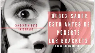 DEBES SABER ESTO ANTES DE PONERTE BRACKETS / CONSENTIMIENTO INFORMADO