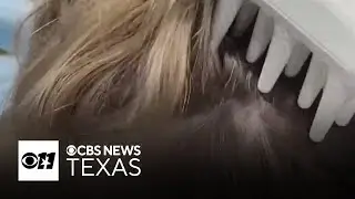 Preventing and treating lice