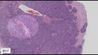 Brain, metastatic breast carcinoma microscopy - Talking slide