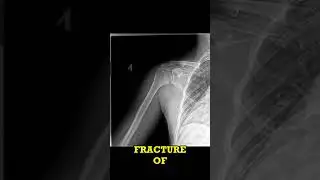 AC Joint Injury X-Ray Findings Short