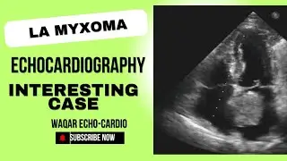 LA #Myxoma interesting case of the day #echocardio #echo 