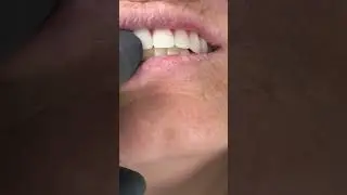 Before making full mouth implants zirconia!
