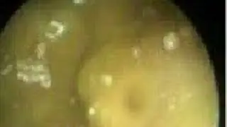 Otoacariasis /otocariasis
