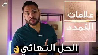 علاج علامات التمدد | علاج علمات التمدد الحمراء والبيضاء في الجسم | تشققات الجلد