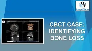 CBCT Case:  Identifying bone loss
