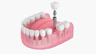 Madison wi dental implants - ct guided dental implants at oak park dental in madison wisconsin