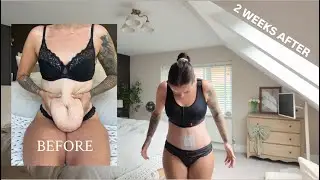 TUMMY TUCK REVEAL | SEEING MY SCAR & BELLY BUTTON FOR THE FIRST TIME | MISS GREEDYS HOME | VLOG