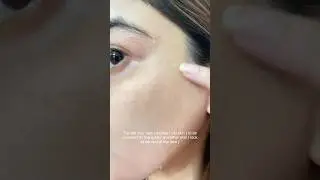 Process and results of Retinol😍 #retinol #purging #peeling #skincare #glassskin #viralvideo #shorts