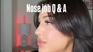Rhinoplasty Update; 11 months post op 