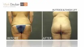 Plastic Surgery After Massive Weight Loss Dallas - Removing Excess Skin