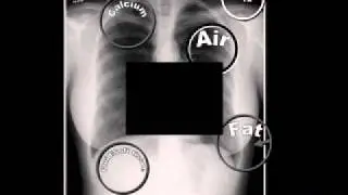 LearningRadiology 01 (5 Radiographic Densities)