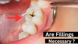 do You REALLY Need To Get A CAVITY Filled? #smilewide #cavityfilling #oralhealth