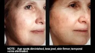 Facial Rejuvenation Acupuncture Before & Afters