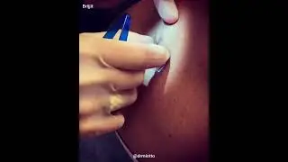 Using the Brijjit to reinforce the sutures (Scar Treatment / Scar Revision)