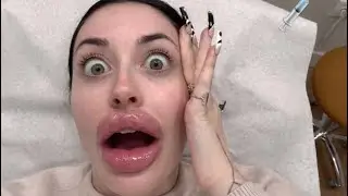 I GOT BOTOX FOR THE FIRST TIME&hellip; *I WAS NOT PREPARED*