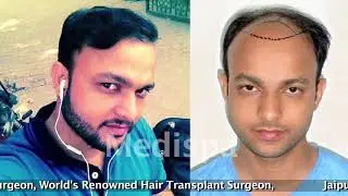 New Hair Transplant @ MEDISPA Jaipur|Delhi | Mumbai | Dr Suneet Soni