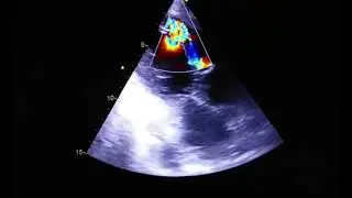 VSR (ventricular septal rupture) case study #echocardiography #heartmonitoring@SafaMedicalLecture
