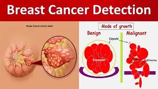 Breast Cancer Detection Using Machine Learning Classifier