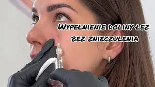 Ostatnie krople kwasu -w dolinę łez. Moja technika bez efektu Tendela!
