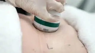 Onda Coolwaves Body Sculpting