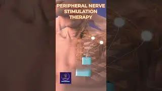 Peripheral Nerve Stimulation Therapy
