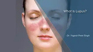 What Is Lupus? | Autoimmune Disease | Lupus Symptoms | Dr Yogesh Preet Singh | Manipal Hospitals.