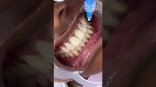 tooth gem process #toothgems #torontotoothgems