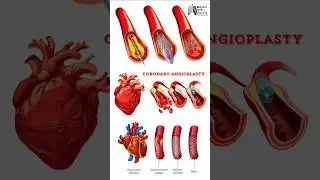 heart stent introduction animation #medical #3d #animation #short | Biology with Aliya