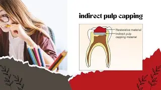 indirect pulp capping || BDS# operative dentistry