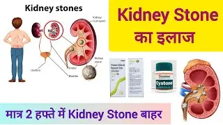 Kidney Stone Treatment in hindi | Kidney Stone का इलाज | #kamlapharmacy #kidneystone #youtube 