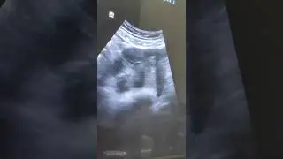 ring of fire  (left ectopic tubal pregnancy)