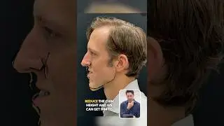 Corrective jaw surgery and geniopalsty for facial asymmetry correction