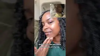 How to heal burn scars / hyperpigmentation 🤎