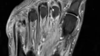 Plantar plate tear toe
