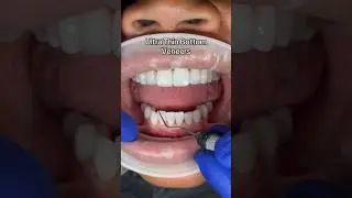Ultra thin Porcelain Veneers #veneers #porcelainveneers #dentalartistry #teeth #bottomteeth