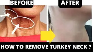Get Rid of Turkey Neck Fast: Easy Face Yoga Exercises for Neck Lines