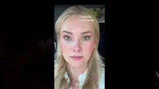 7 Semanas Post-Op: SMAS Endoscopic Mid Face Lift, Brow Lift y Resecci&oacute;n de Corrugadores