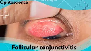Follicular conjunctivitis | symptoms|Treatment|prevention|Season of follicular conjunctivitis 2024