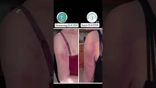 Scar healing #anftherapy