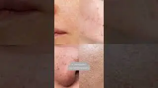 🔥 Лучший продукт для заживления воспалений #косметика #косметология